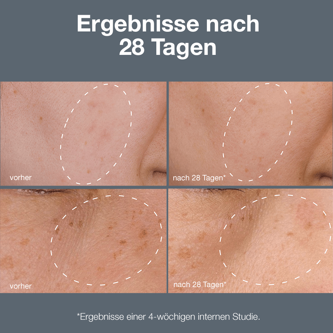 Vorher-Nachher-Vergleich des Hautbildes nach einer 28-tägigen Behandlungsstudie mit dem Powerbright Dark Spot System.