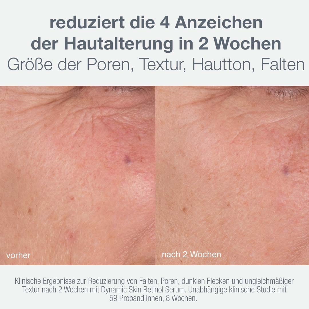 Die nebeneinander dargestellten Bilder zeigen eine deutliche Verbesserung der Hautporen, der Hautstruktur, des Hauttons und der Falten nach zweiwöchiger Anwendung des Skin Aging Solutions Sets. Der deutsche Text beschreibt, wie dieses Anti-Aging-Pflegeset Hautalterung effektiv bekämpft und hebt beeindruckende klinische Ergebnisse hervor.