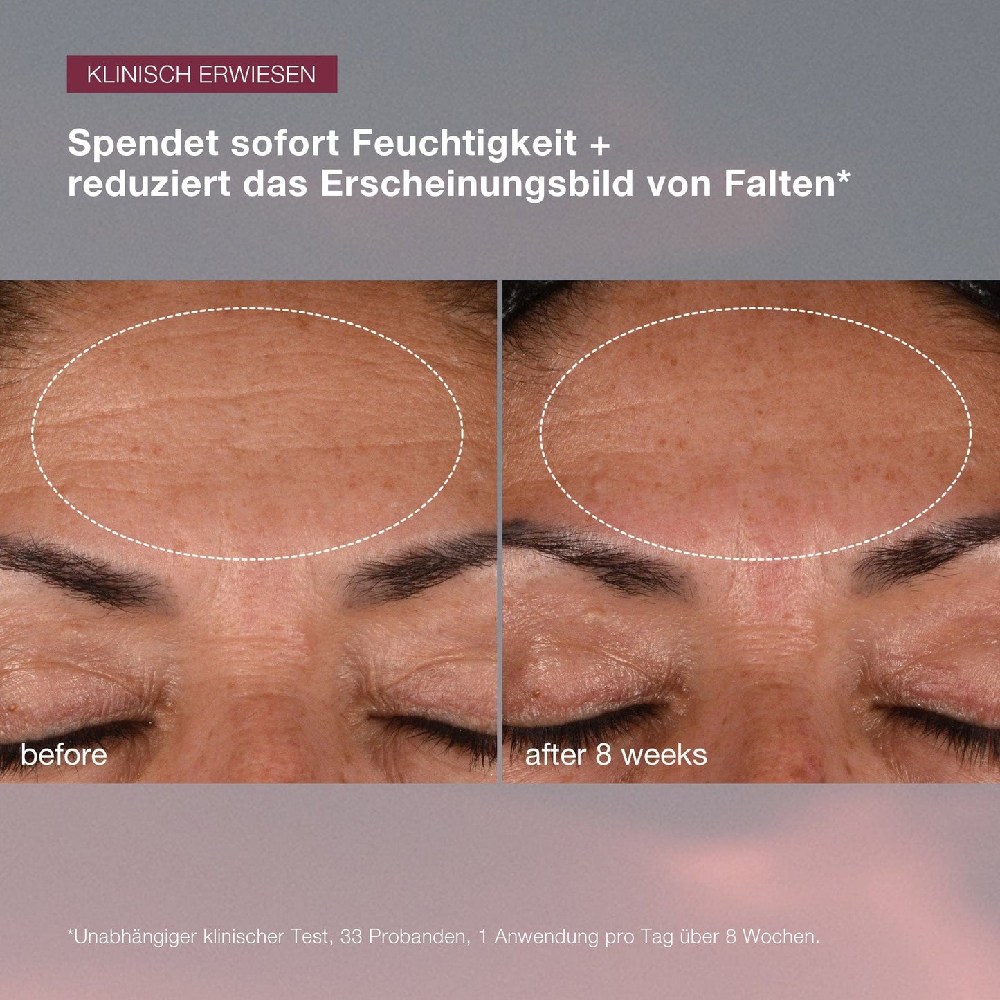 Nahaufnahme der Stirn einer Person, die die Verringerung der Fältchenbildung hervorhebt.