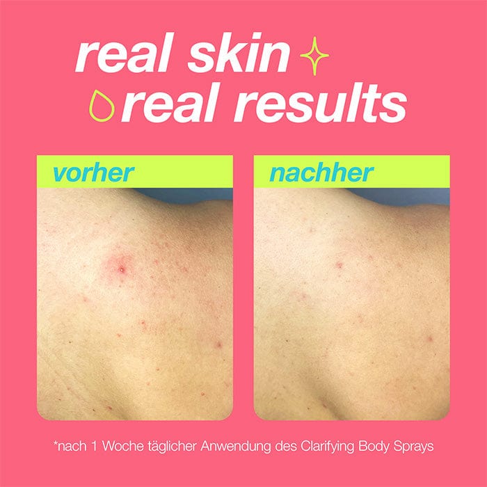 Seitenvergleich der Haut vor und nach einer Woche täglicher Anwendung von Clarifying Body Spray + Daily Microfoliant, mit weniger Rötungen und Unreinheiten. Text auf Deutsch.
