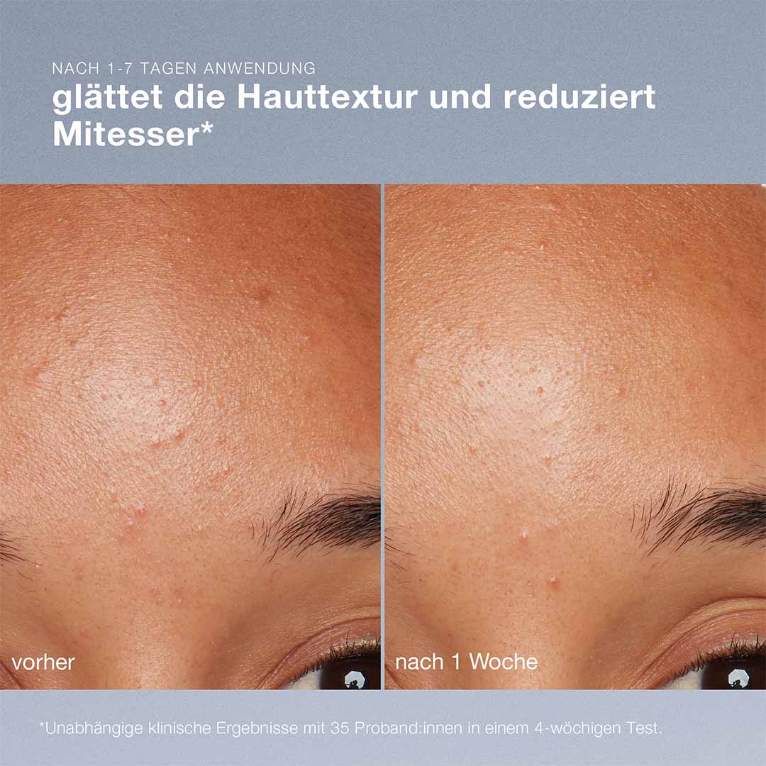 Ein Nahvergleich der Hautstruktur vor und nach der einwöchigen Anwendung von Daily Microfoliant | Gesichtspeeling zeigt eine Reduzierung der Mitesser. Der Text ist in deutscher Sprache und enthält klinische Testergebnisse, die die Wirksamkeit dieses Hautaufhellungskomplexes belegen.