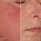 Nahaufnahme eines Gesichts mit empfindlicher Haut: die linke Seite zeigt Rötungen vor der Anwendung; nach 1 Woche Anwendung der Stabilisierenden Repair Creme + UltraCalming Cleanser sieht die rechte Seite klarer und ruhiger aus.