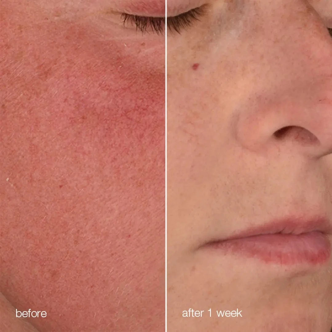 Nahaufnahme eines Gesichts mit empfindlicher Haut: die linke Seite zeigt Rötungen vor der Anwendung; nach 1 Woche Anwendung der Stabilisierenden Repair Creme + UltraCalming Cleanser sieht die rechte Seite klarer und ruhiger aus.