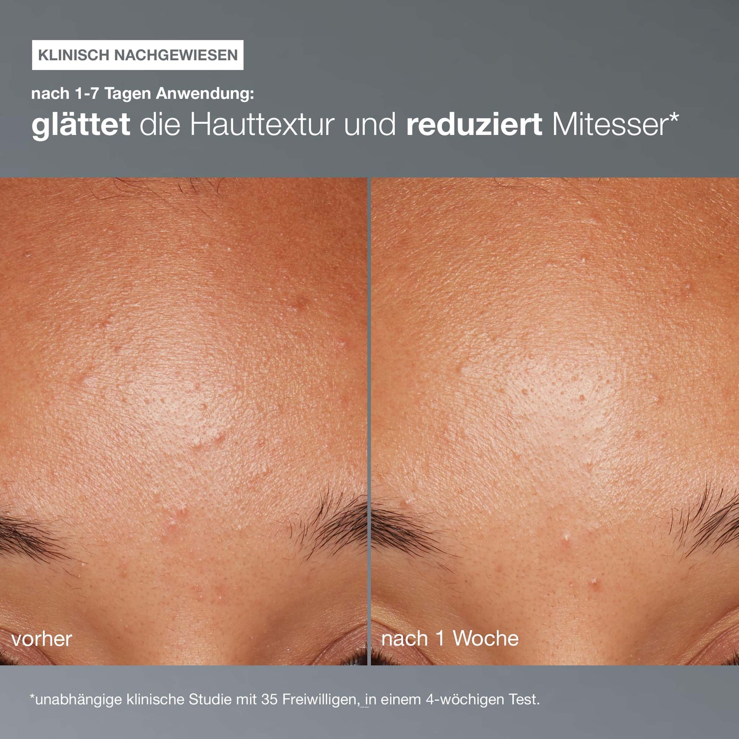 Nahaufnahme einer Stirn vor und nach einwöchiger Anwendung von Daily Microfoliant, die ein sichtbar glatteres Hautbild und weniger Unreinheiten zeigt - ideal zur Verfeinerung des Teints.