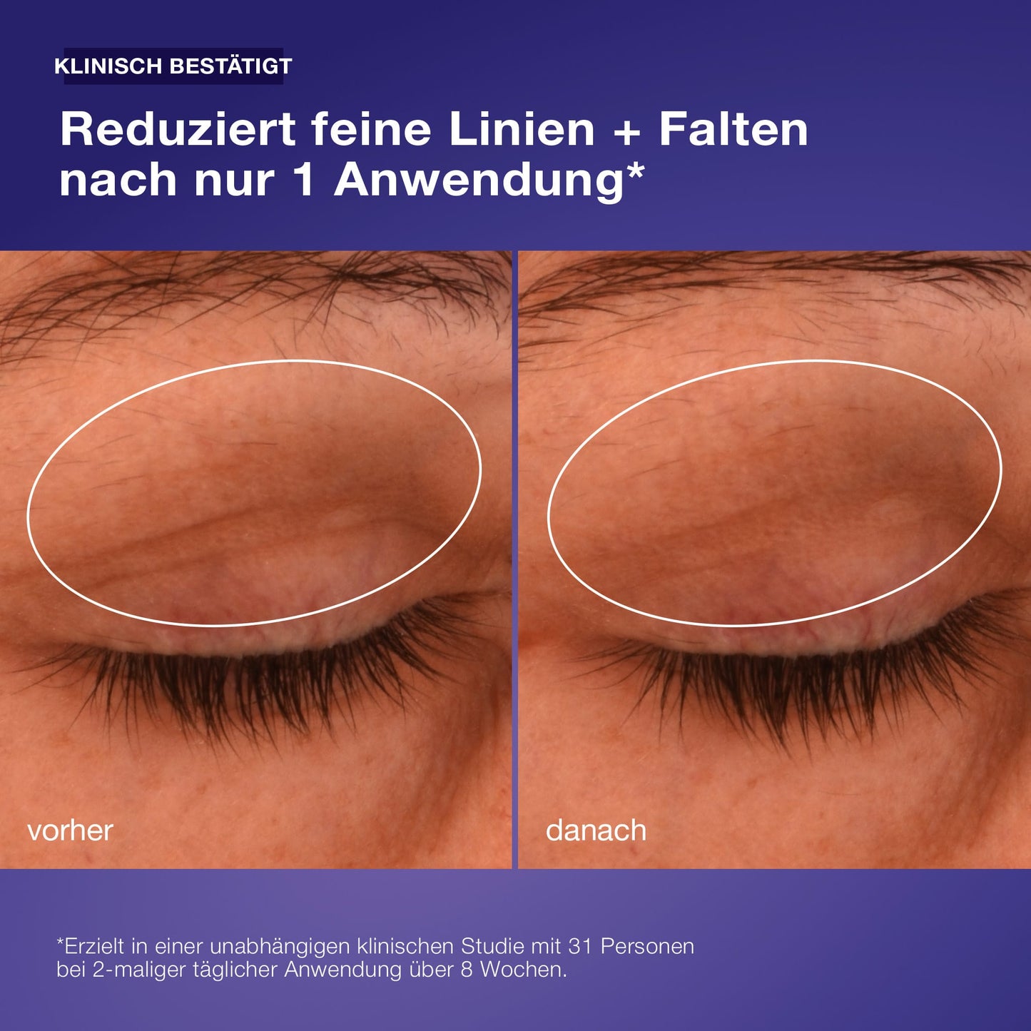Vorher- und Nachher-Fotos der Augenpartie einer Person zeigen, dass feine Linien und Fältchen nach der Anwendung der Phyto Nature Lifting Eye Cream reduziert wurden. Der Text hebt die Augenlidstraffung und den Lifting-Effekt hervor.