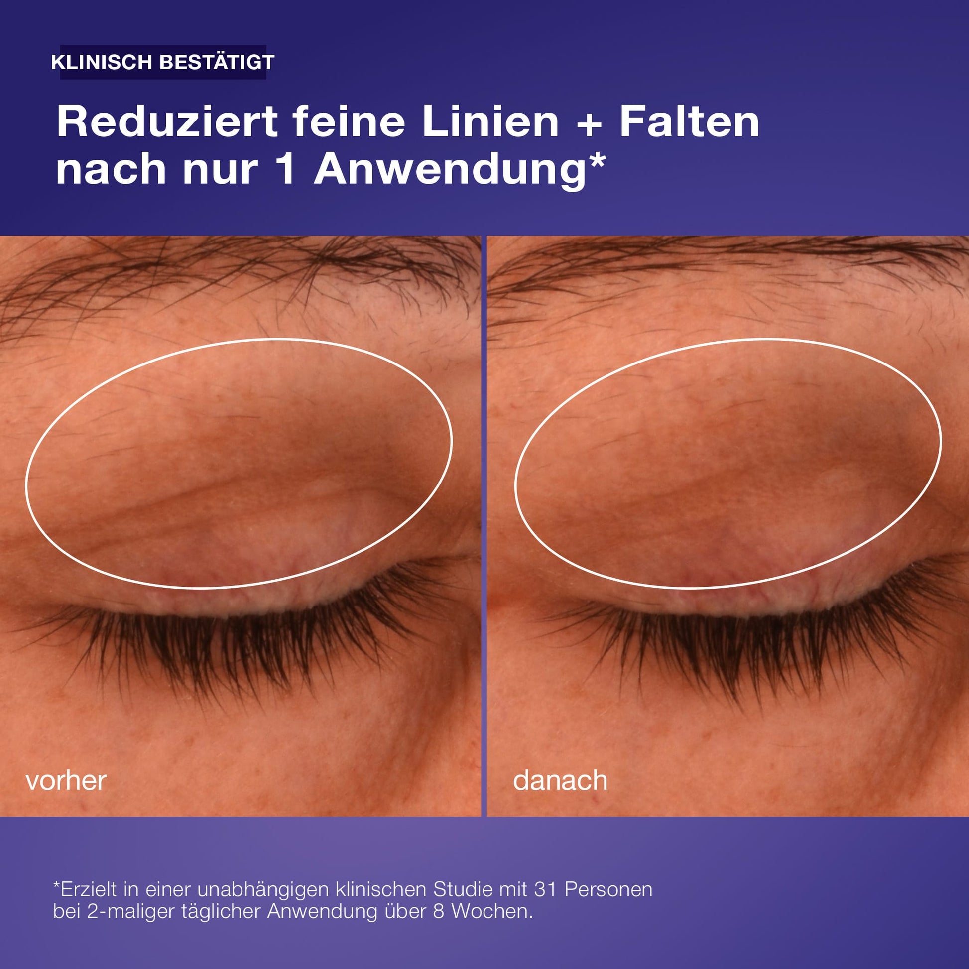 Vorher- und Nachher-Fotos der Augenpartie einer Person zeigen, dass feine Linien und Fältchen nach der Anwendung der Phyto Nature Lifting Eye Cream reduziert wurden. Der Text hebt die Augenlidstraffung und den Lifting-Effekt hervor.