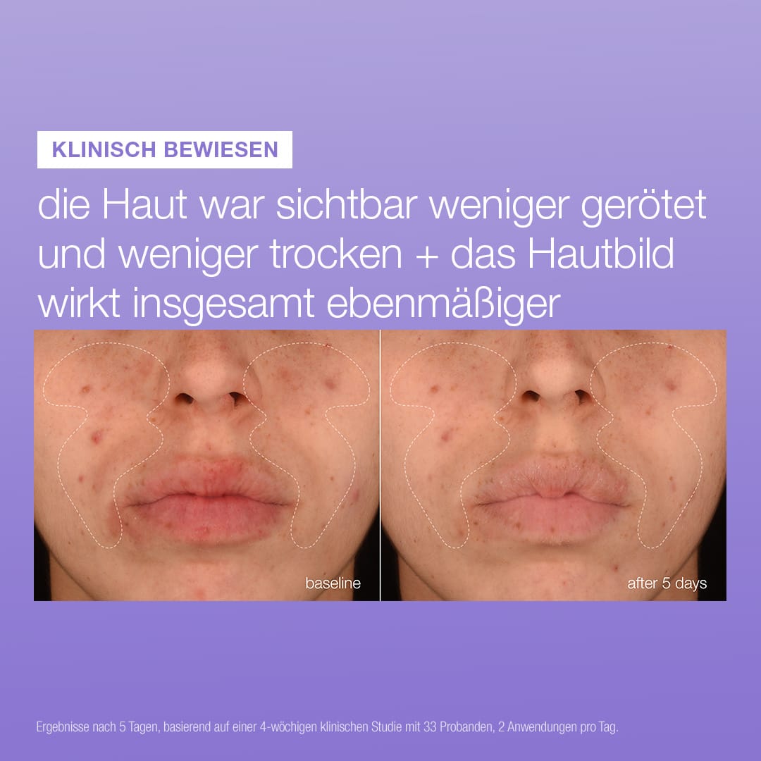 Vorher-Nachher-Fotos des unteren Gesichtsbereichs einer Frau zeigen nach 5-tägiger Anwendung des „Stabilizing Repair Serums“ weniger Rötungen und Trockenheit; der deutsche Text enthält den Hinweis „Hautbarriere stärken“ sowie klinische Ergebnisse.
