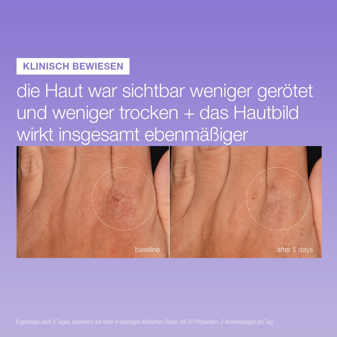 Zwei Nahaufnahmen der Hände zeigen einen eingekreisten Hautbereich, wobei der Ausgangszustand mit dem Ergebnis nach 5 Tagen mit dem „Stabilizing Repair Serum“ verglichen wird – Rötungen und Trockenheit sind sichtbar reduziert.