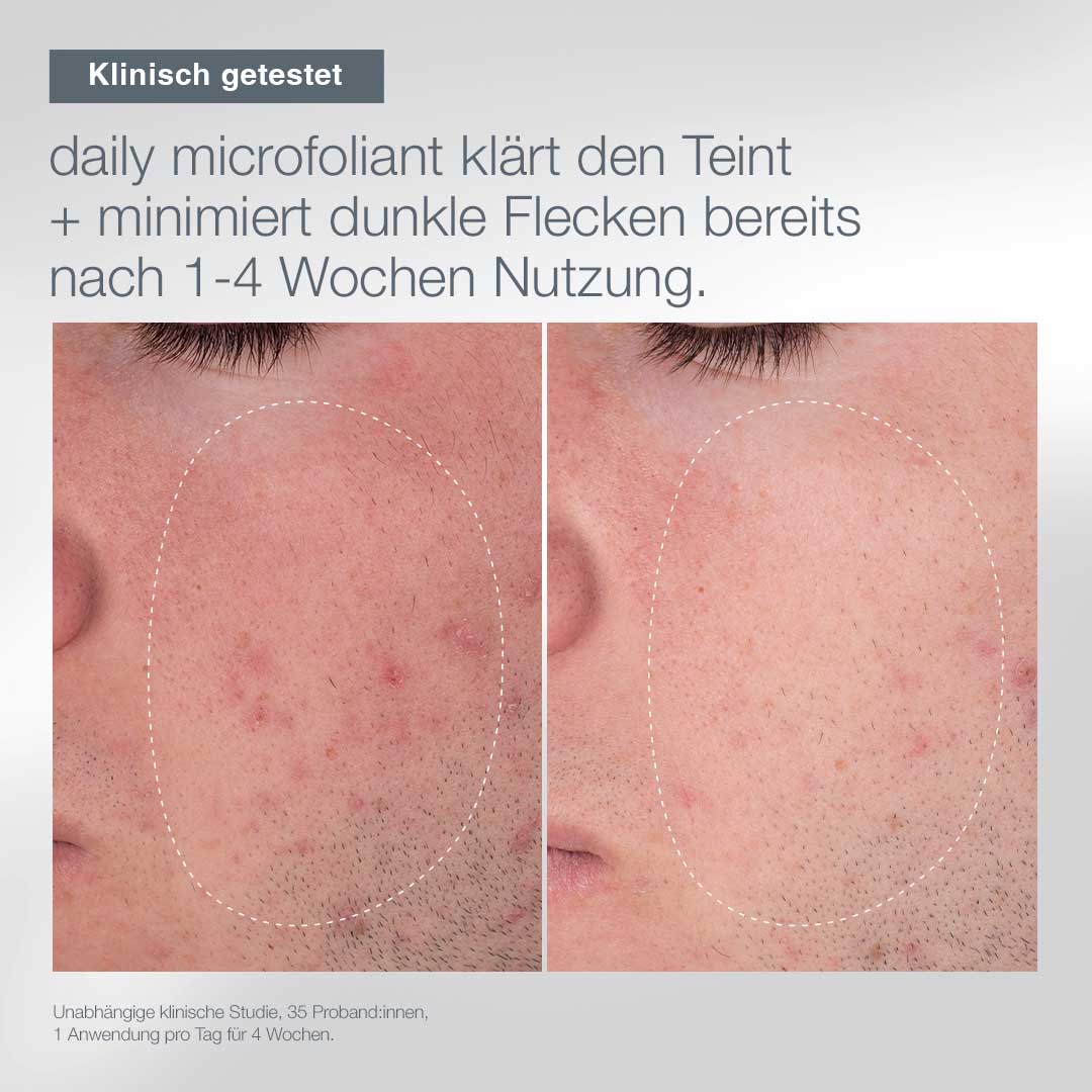 Nebeneinander liegende Nahaufnahmen einer Wange vor und nach 1-4 Wochen Anwendung des Warmth of the Winter Sun Sets, die die Reduzierung dunkler Flecken und eine klarere Haut in den hervorgehobenen Bereichen zeigen.